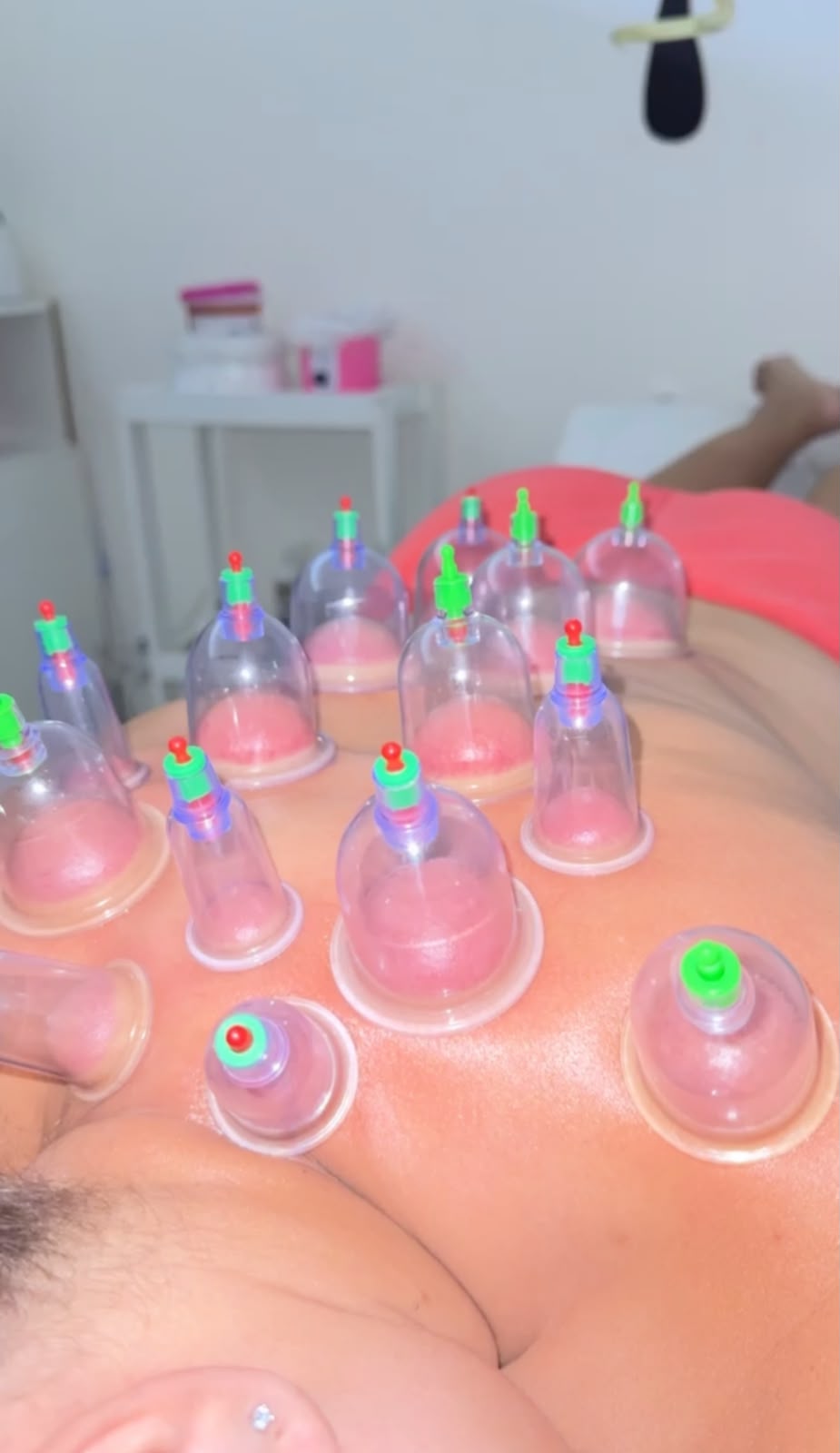 Vacuoterapia